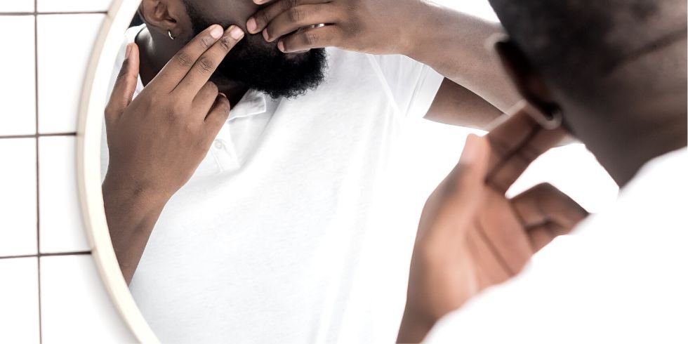 3 Dicas Eficientes para Eliminar Espinhas do Rosto